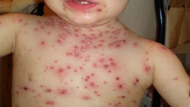 85% din cazuri raportate aici. Ce arată datele Fundaţiei Friedrich Ebert despre situaţia alarmantă şi importanţa vaccinării pentru prevenirea răspândirii bolii extrem de contagioase în perioada 2024-2025?